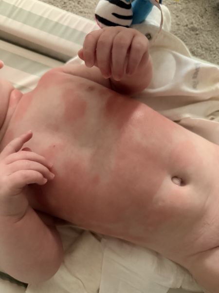 Help needed - Baby Rash