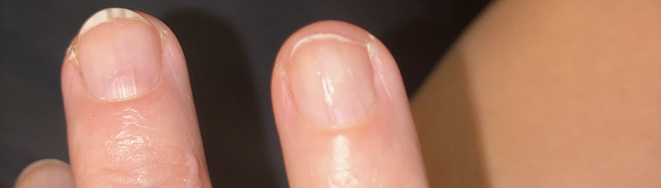 Scabies (again!) How long to get believed that you still have it following treatment?!