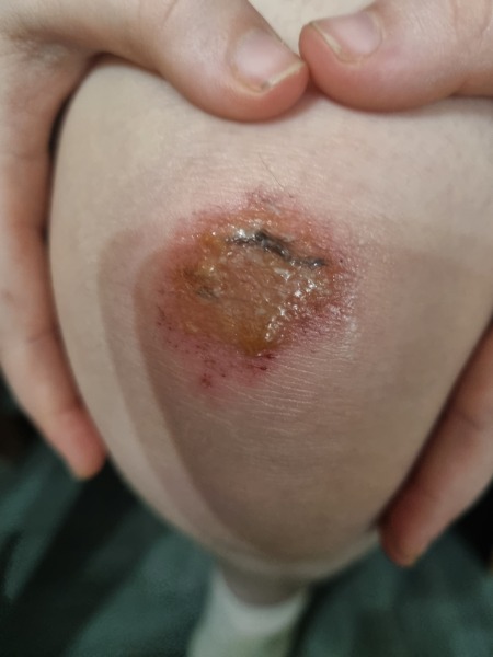 Does this wound  look infected