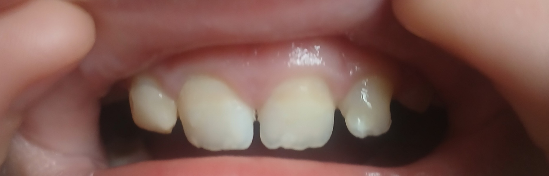 Child's baby teeth keep coming out with root