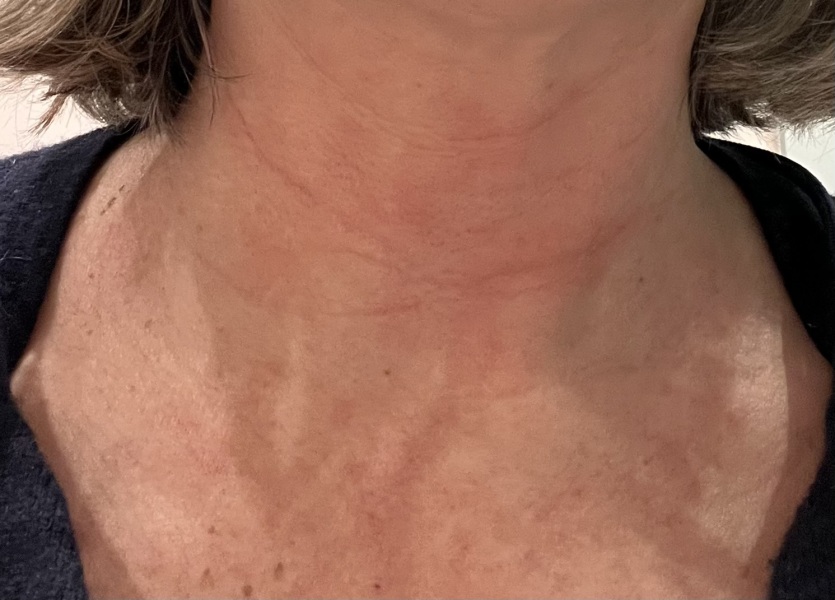 Can anyone help diagnose my neck skin?