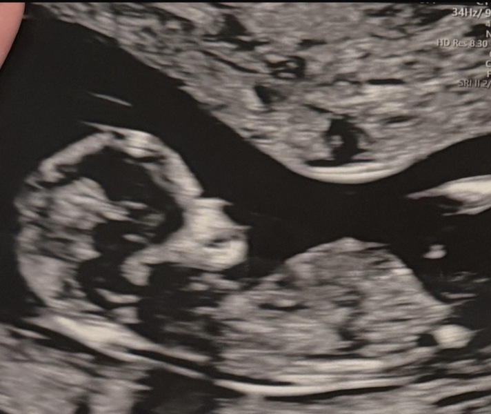 Can anyone guess baby’s gender from my 12 week scan?