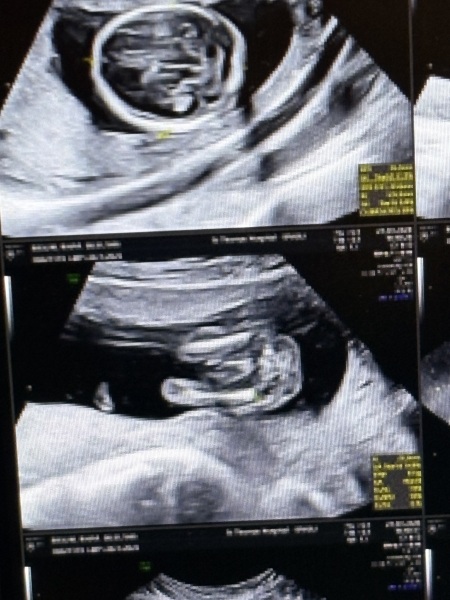 Boy or girl 16 week blurry potty shot