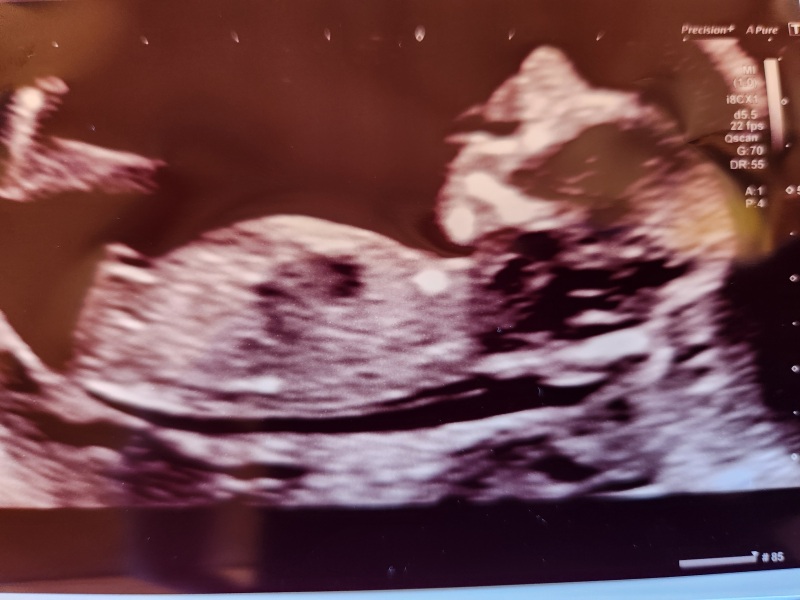 Any guesses on baby’s gender at 13 weeks, just for fun?
