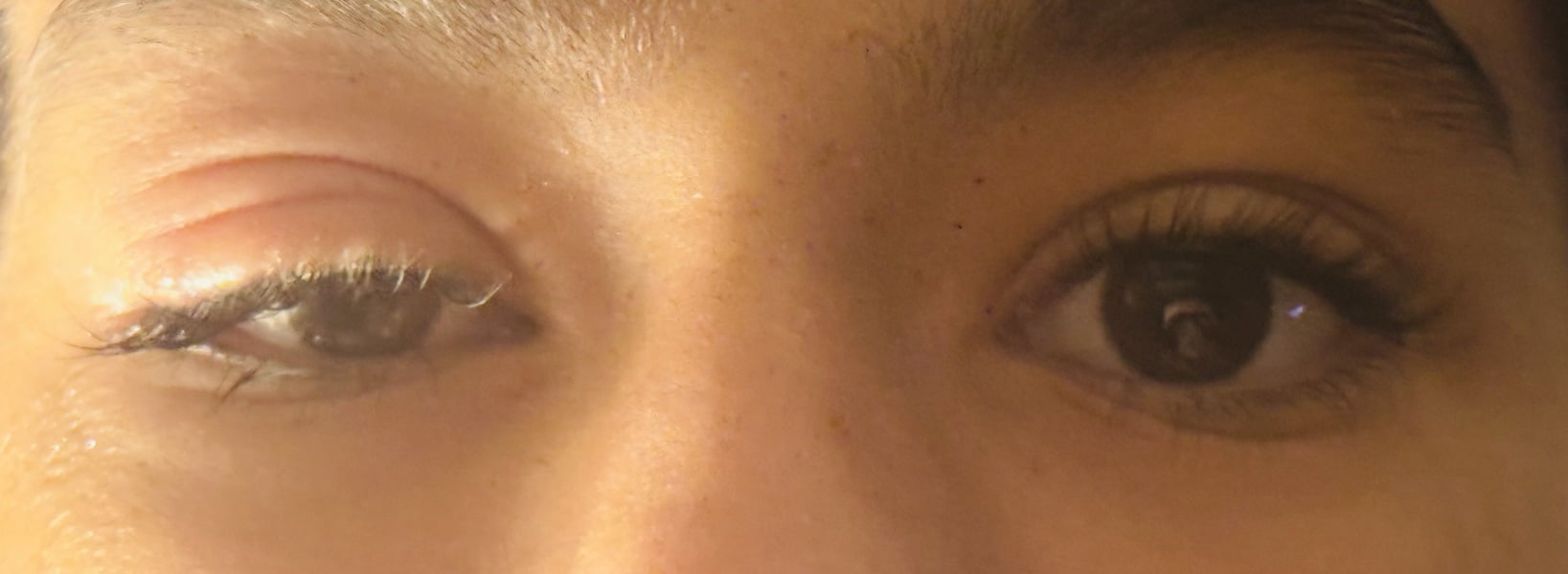 Help asap pls dc eyelid drooping (see image) and panicking