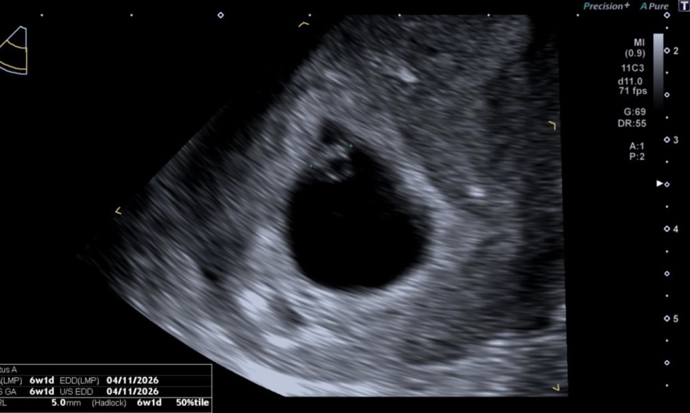 6 week pregnant spotting and cramping heartbeat seen on scan, others experienced this?