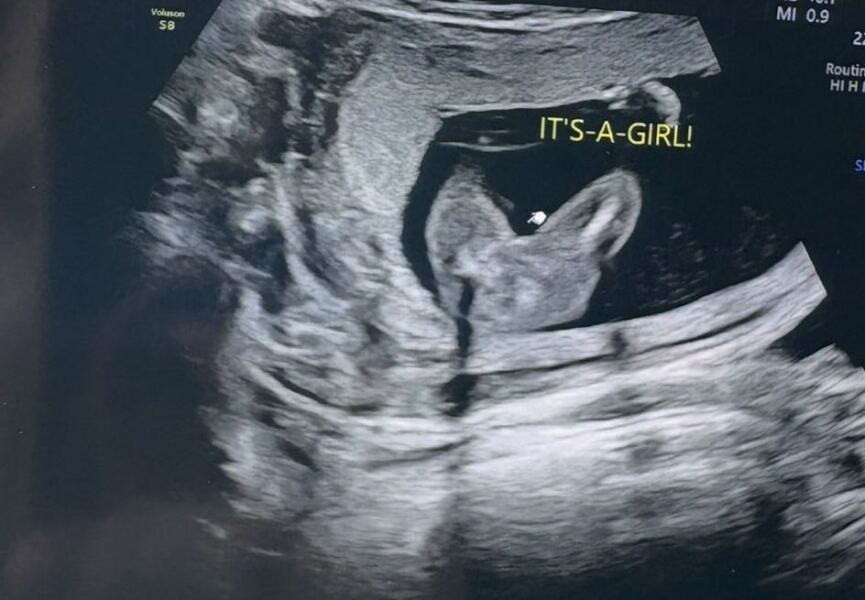 Girl scan - no 3 lines