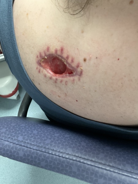 Sporner Corner update on wound healing progress and recovery timeline