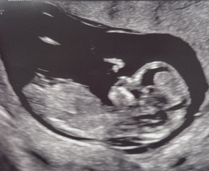 Can anyone see a nub on this 12+2 scan photo?
