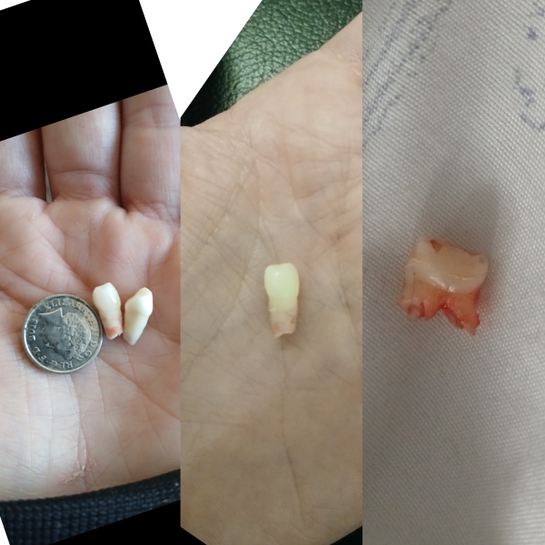 Child's baby teeth keep coming out with root