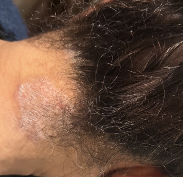 Does this rash look more like psoriasis or ringworm?