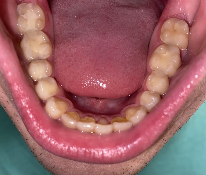 Tartar Buildup (photo)