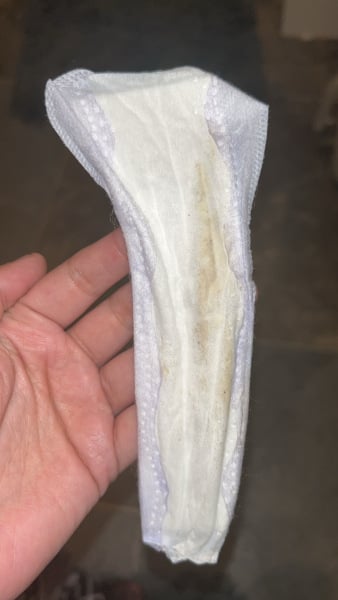 Tan discharge and pelvic pain three weeks after McDonald cerclage