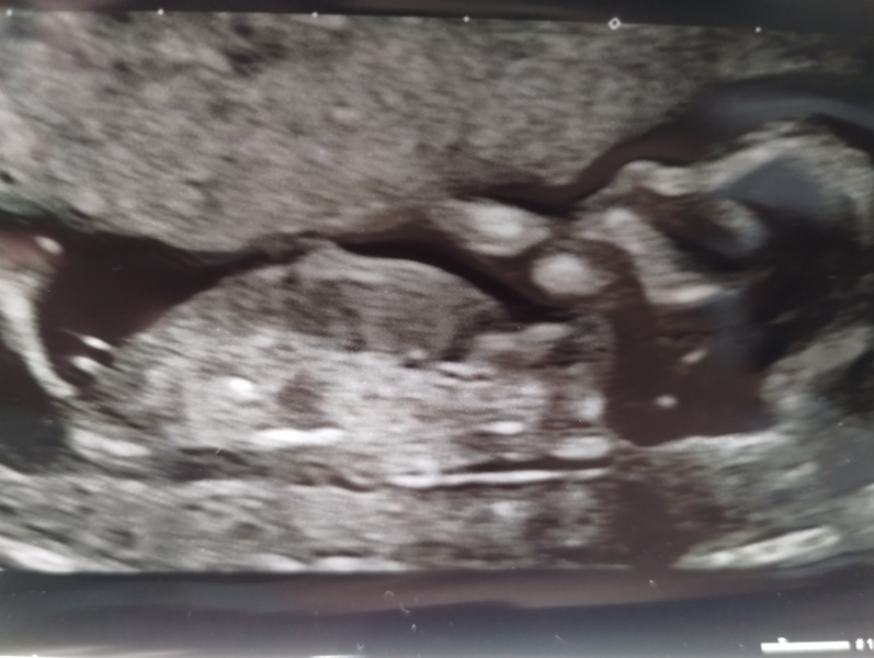 Gender guesses 13w scan