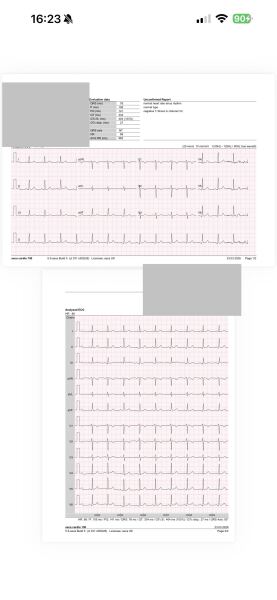ECG worries