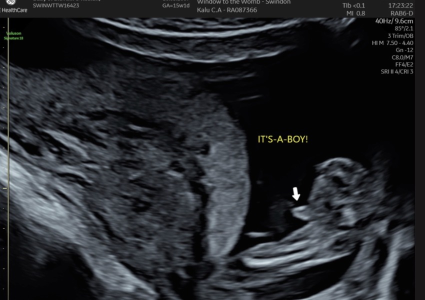 Nub theory? 12 weeks 4 days