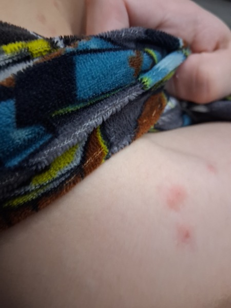To ask if these are bed bug bites