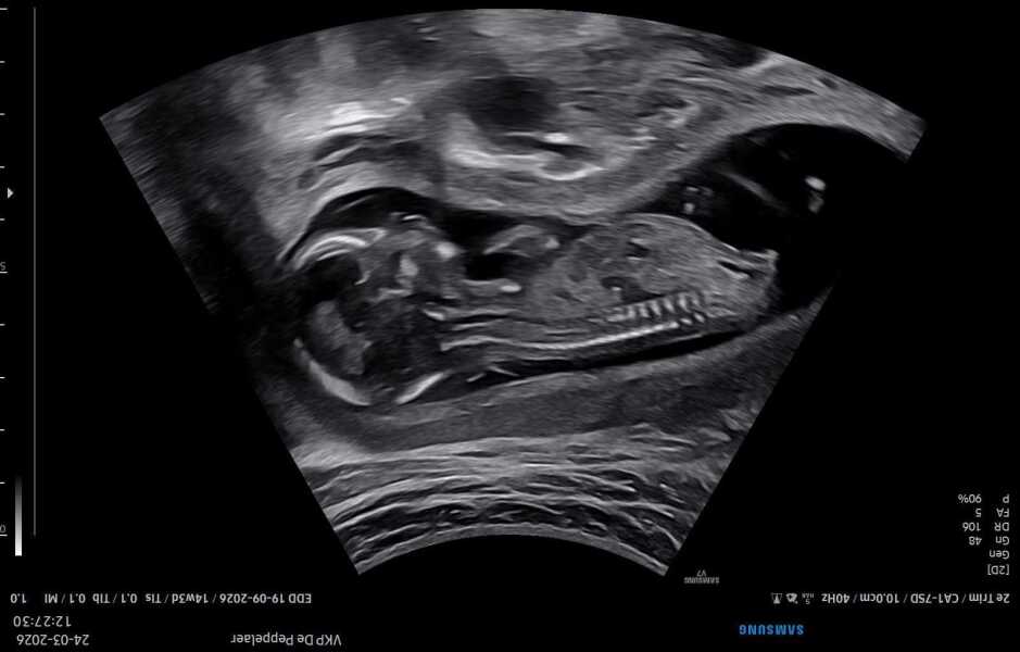 Nub Theory Experts Needed! 14 Weeks. Boy or Girl?