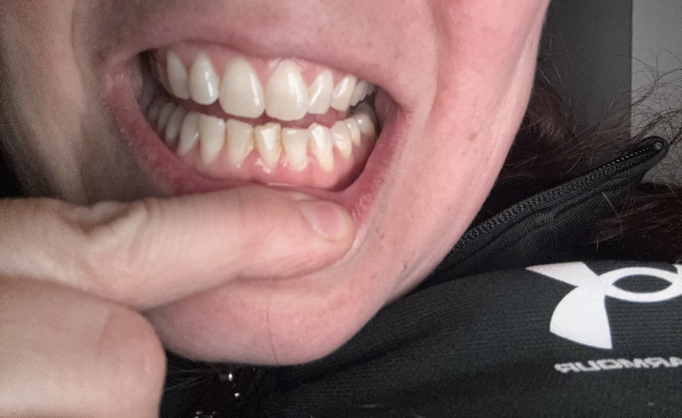To be worried about my teeth . Any dentists here? Trigger pic possible