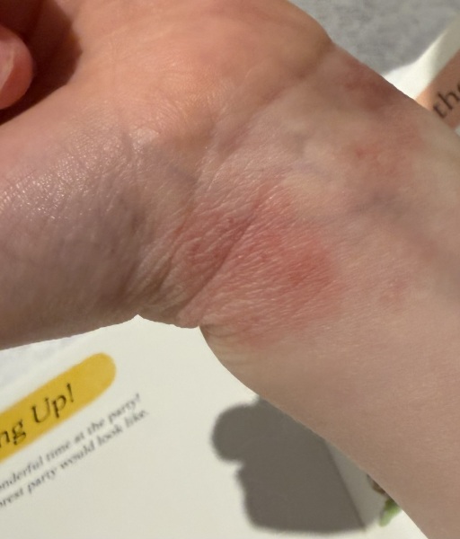 To think this is actually ringworm?!