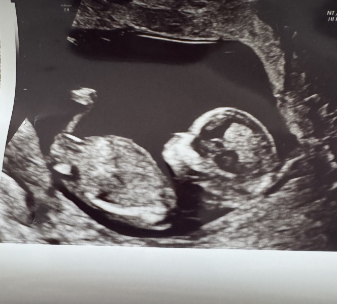 Gender predictions please!