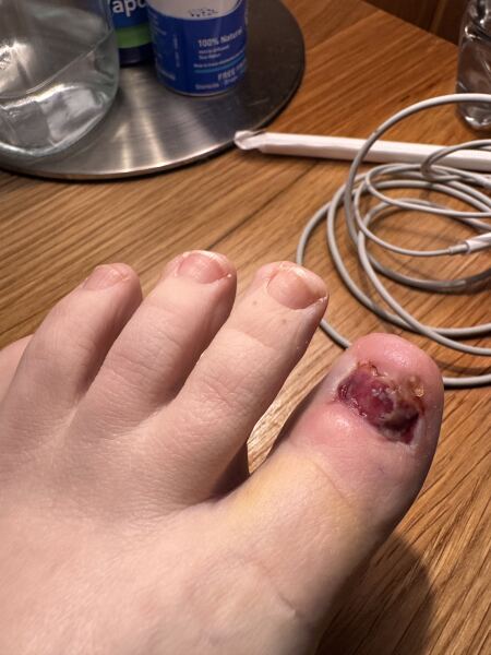 Does this toe nail look infected or not?