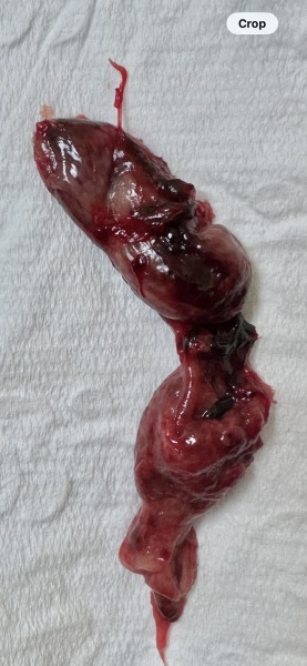 Is this the gestational sac? TW; photo