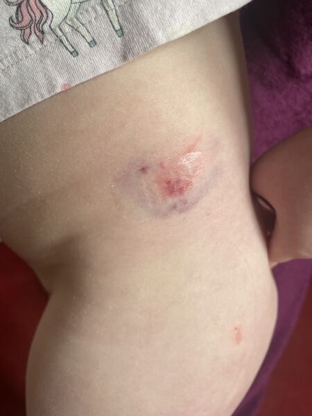 Dog bite or scratch?