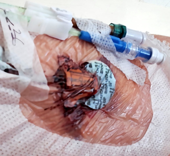 It wasn't ovarian, it was lymphoma