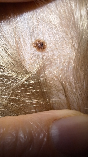 Would this growing mole worry you?