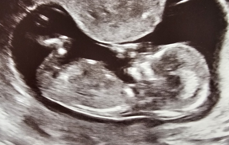 Boy or Girl guesses at 13 weeks 4 days scan?