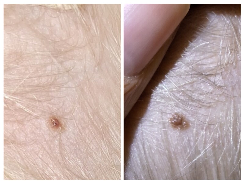 Need a handhold - urgent derm referral for a bad scalp mole 3yo