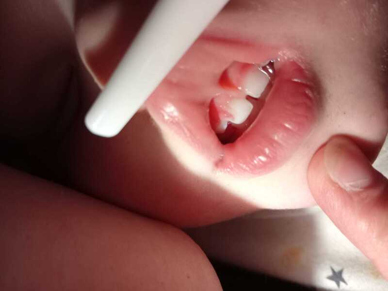 18mo gum hanging off (picture)