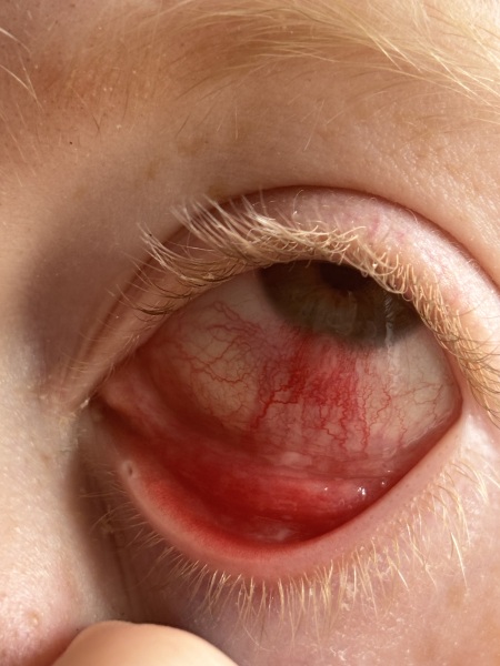 Has anyone ever seen and eye infection like this?  Warning horrifying eye picture.