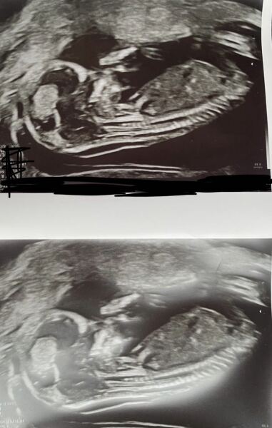 Boy or Girl? Nub Theory?