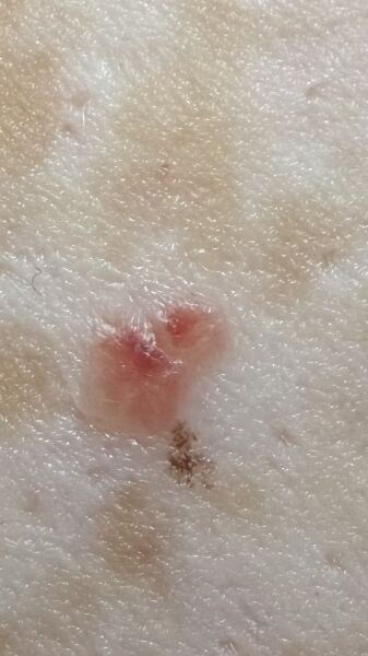 Suspected skin cancer