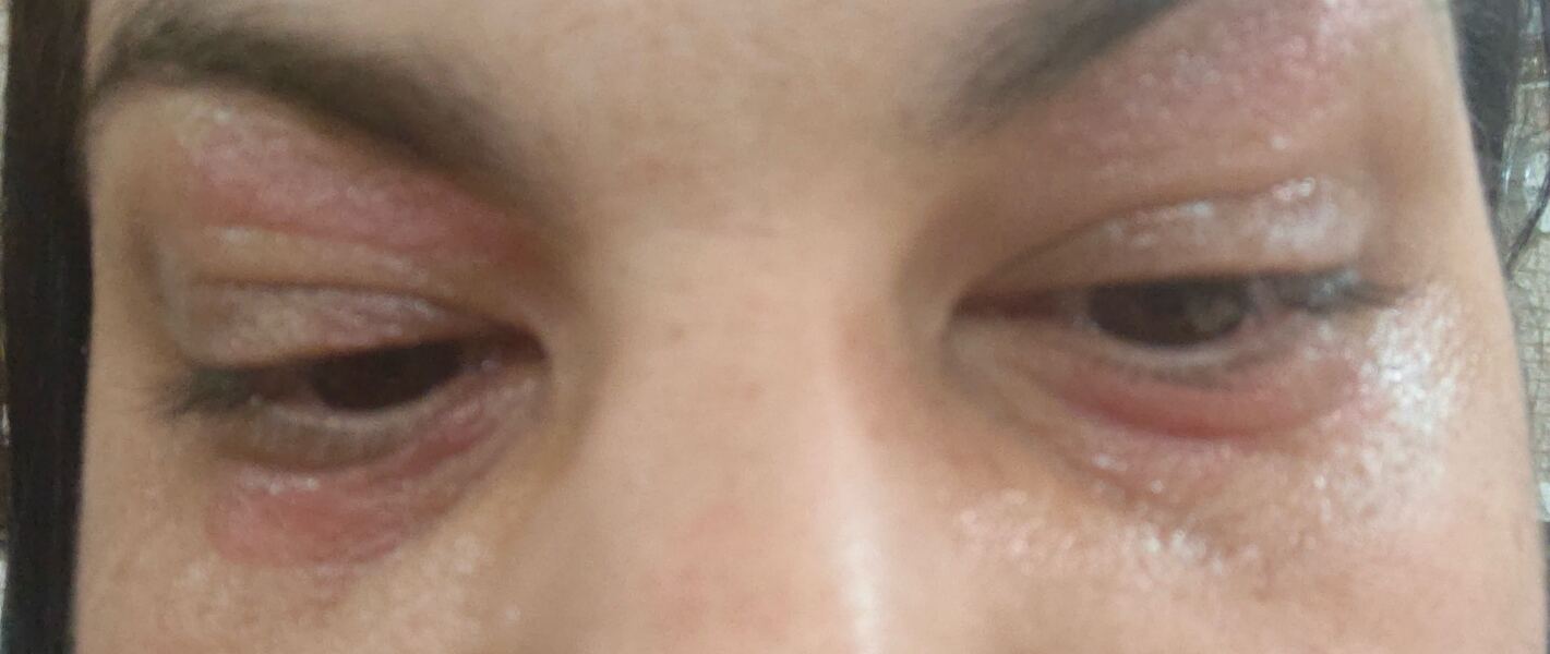 Has anyone had sudden skin issues like rashes, dry patches or breakouts?