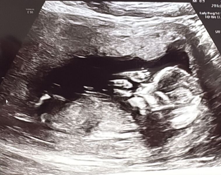 Skull/nub theory?? Boy or girl? 💖💙