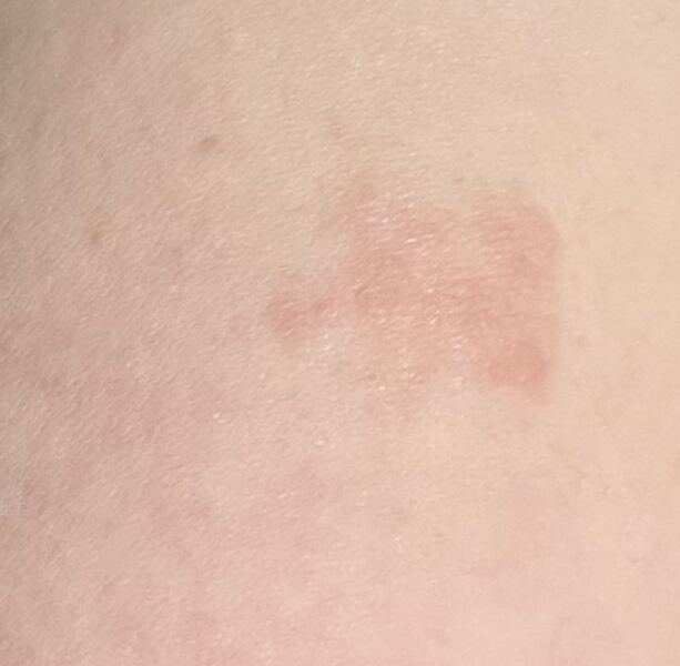 Does this look like basal cell or another type of skin cancer?