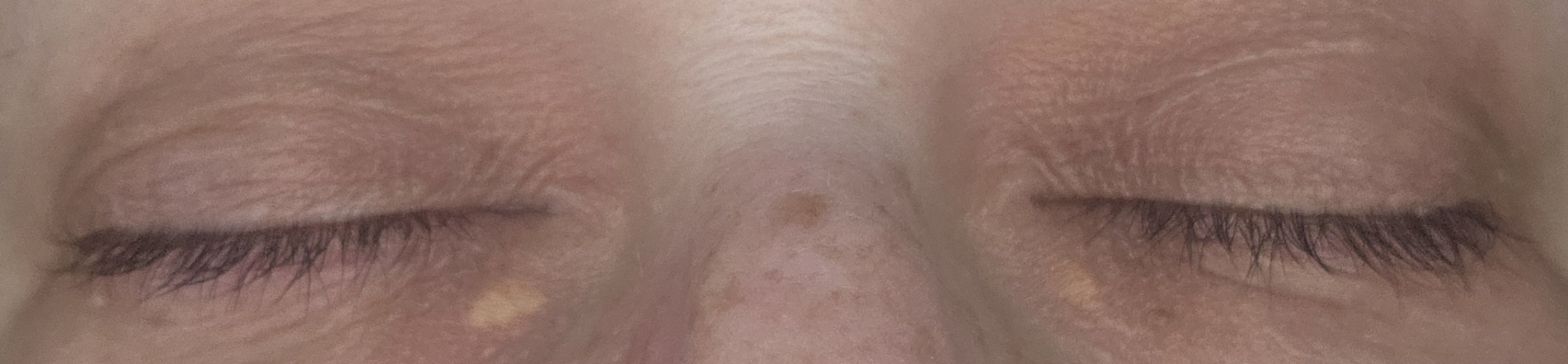 Has anyone had xanthelasma removed?