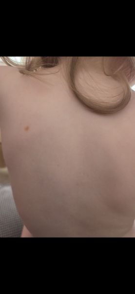 Does this look like the beginning stage of chickenpox