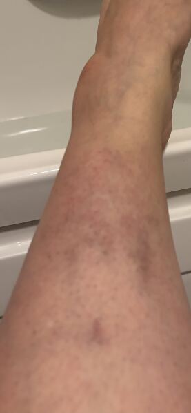 Does anyone know what these marks are on my leg please?