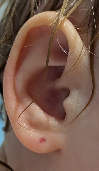 Anyone have any idea what this could be on my 16 month old's ear?