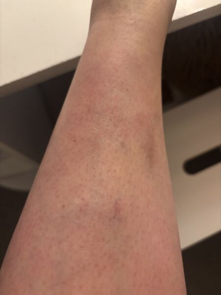 Does anyone know what these marks are on my leg please?