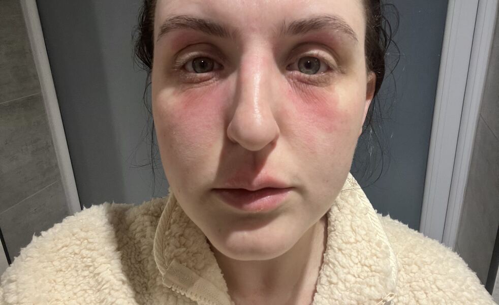Thyroid and skin conditions