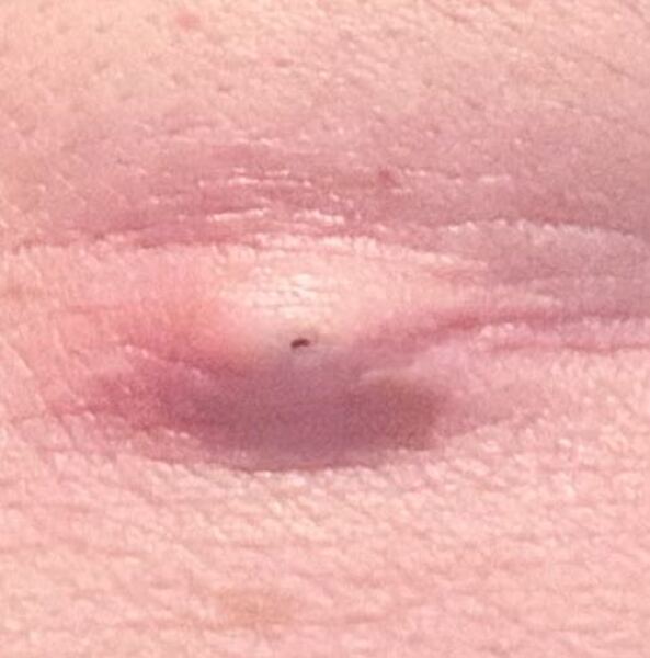 Painful spot getting infected - what to do?