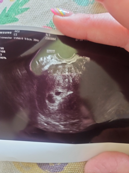 5 weeks, 6 days scan, possible twins?