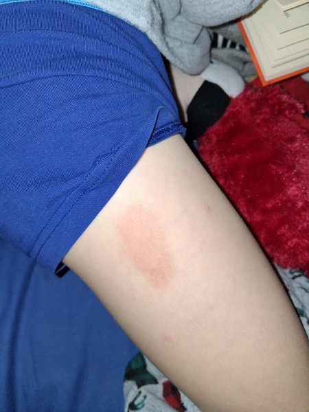 Persistent unexplained mark on child’s leg after chicken pox treatment