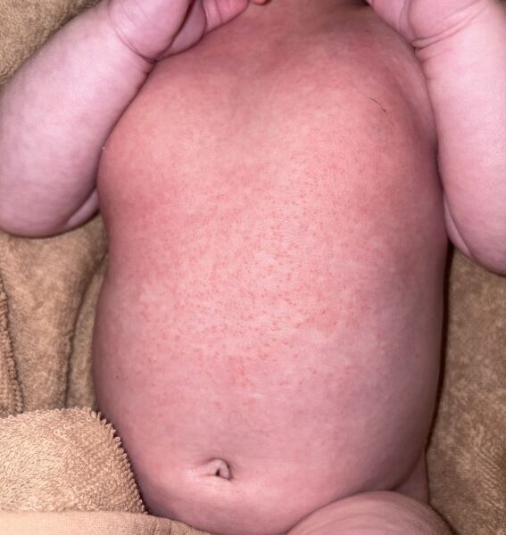 Baby rash