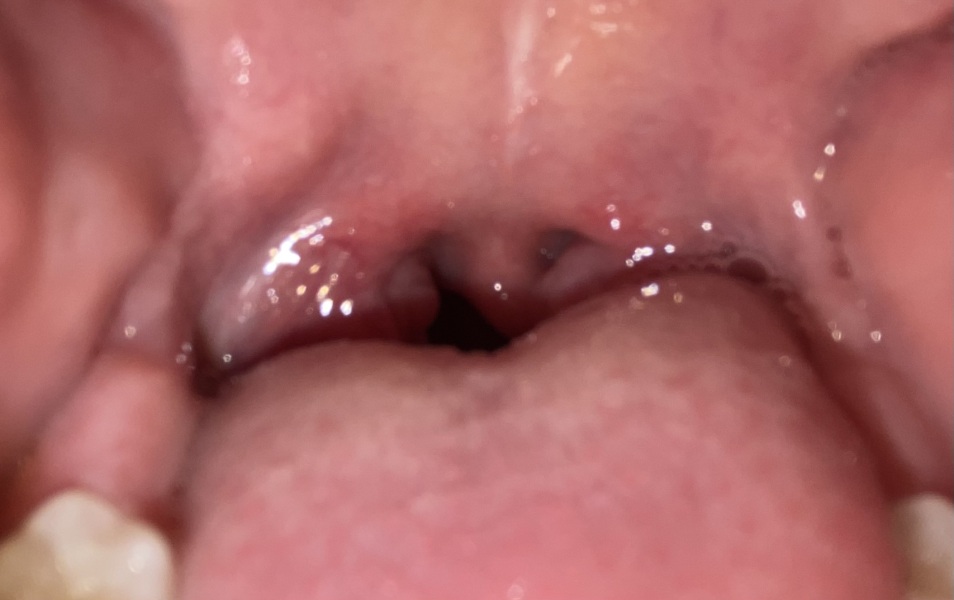 Constantly enlarged tonsils in 3.5yo